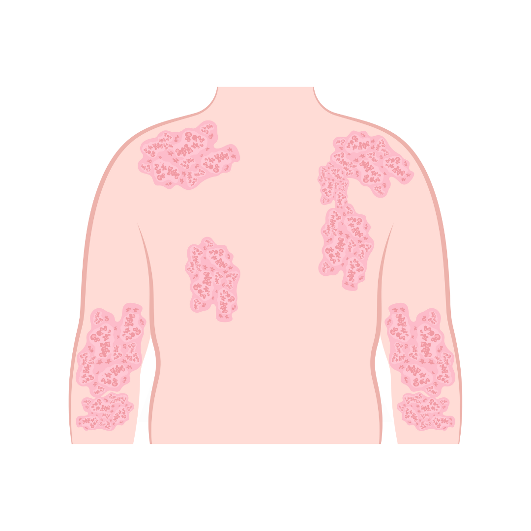 atopic-dermatitis-neurodermatitis-and-the-use-of-essential-oils-eoassist