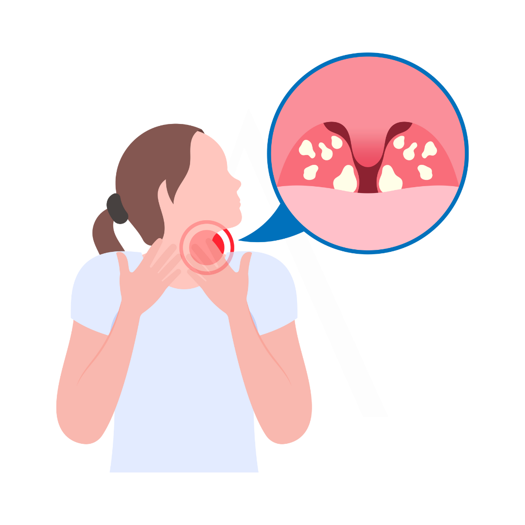 Tonsillitis Symptoms and Wellness Support