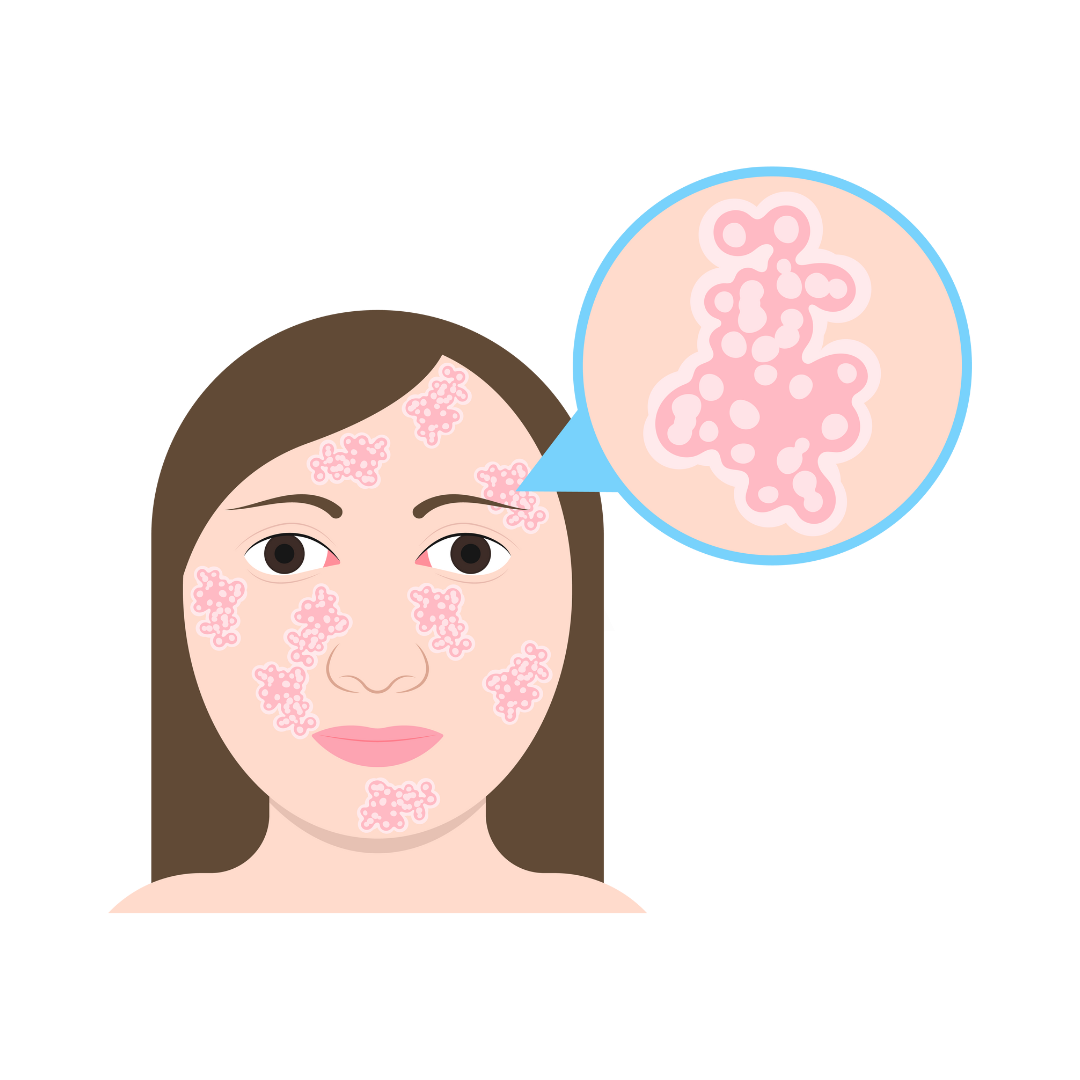 Rosacea And The Use Of Essential Oils rosacea-and-the-use-of-essential-oils