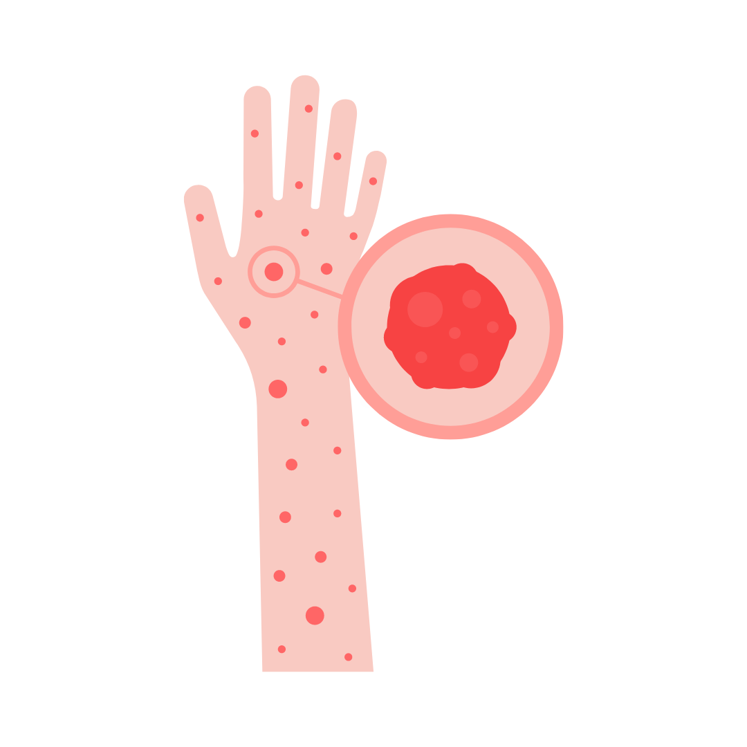 Hives And The Use Of Essential Oils hives-and-the-use-of-essential-oils